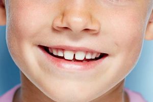 implantes dentales infantiles